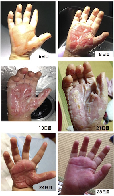 手の火傷に対する湿潤療法